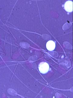 White blood cells among semen cells